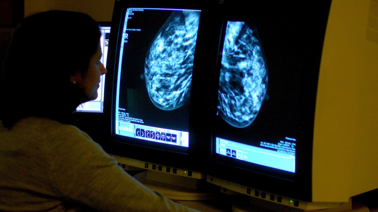 Targeted drug shrinks tumors in 3 out of 4 patients with advanced breast cancer — Riverview Schools news